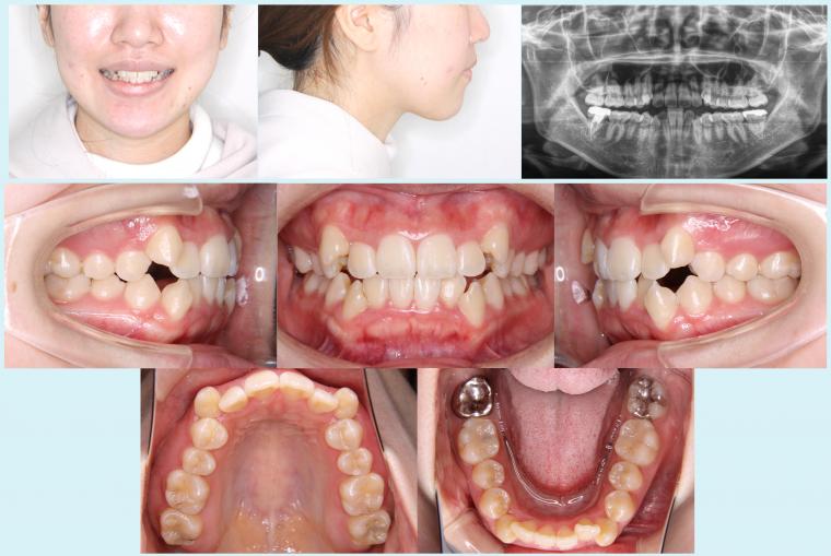 #33　表側矯正装置で八重歯を治療した症例