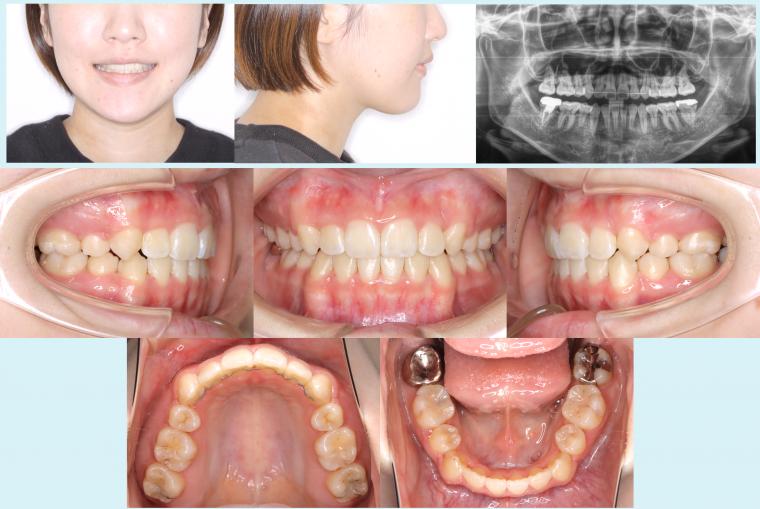 #33　表側矯正装置で八重歯を治療した症例