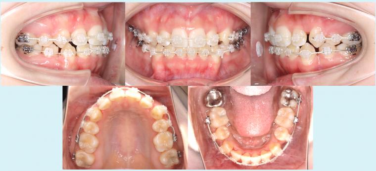 #33　表側矯正装置で八重歯を治療した症例