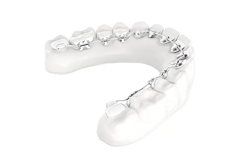 カスタムメイド型リンガルブラケット矯正装置（WIN）とは